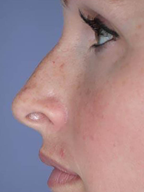 Rhinoplasty Before & After Image