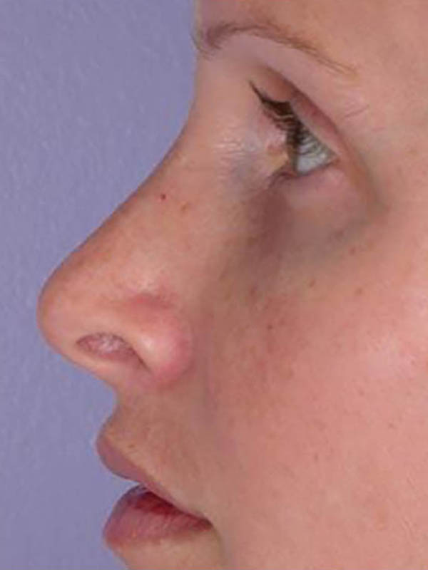 Rhinoplasty Before & After Image