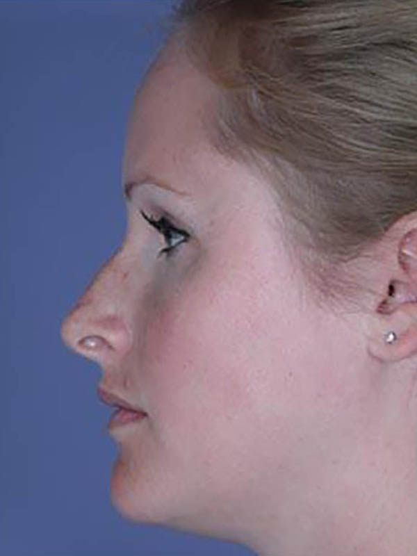 Rhinoplasty Before & After Image