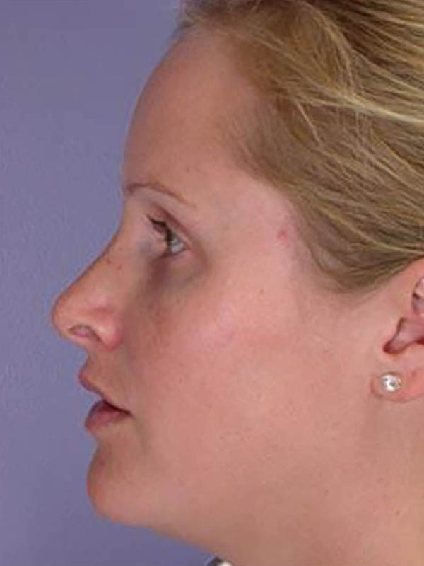 Rhinoplasty Before & After Image