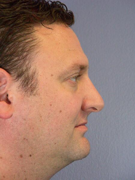 Rhinoplasty Before & After Image