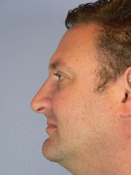 Rhinoplasty Before & After Image