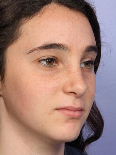 Rhinoplasty Before & After Image