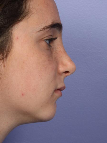 Rhinoplasty Before & After Image