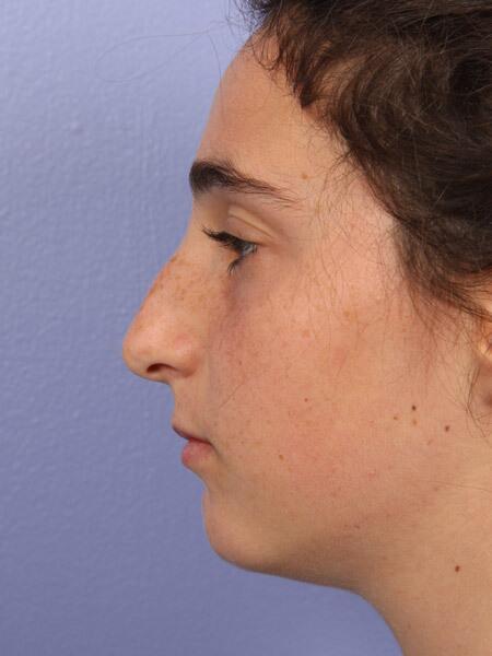 Rhinoplasty Before & After Image