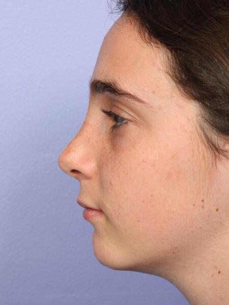 Rhinoplasty Before & After Image