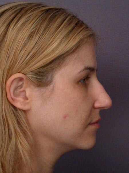 Rhinoplasty Before & After Image