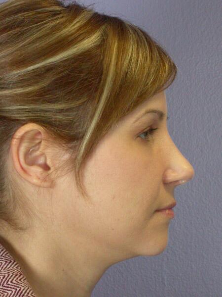 Rhinoplasty Before & After Image