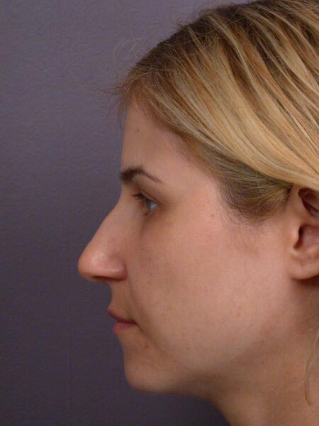 Rhinoplasty Before & After Image