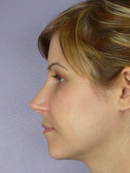 Rhinoplasty Before & After Image