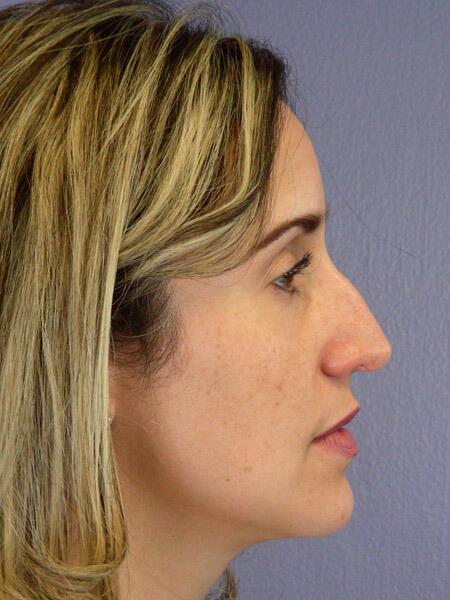 Rhinoplasty Before & After Image