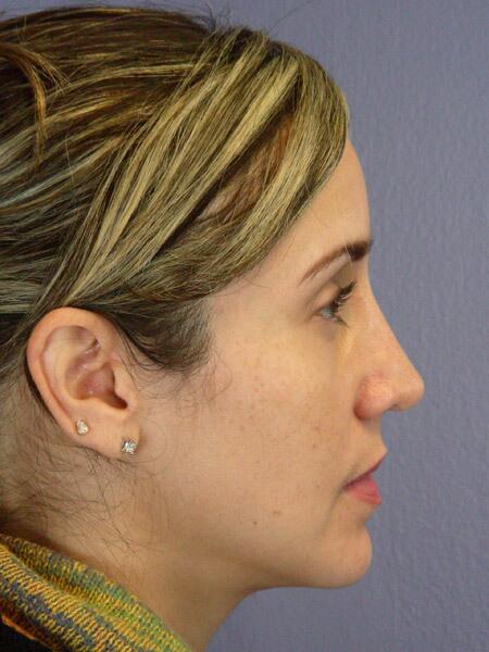 Rhinoplasty Before & After Image