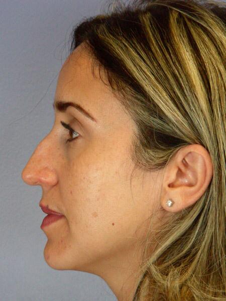 Rhinoplasty Before & After Image