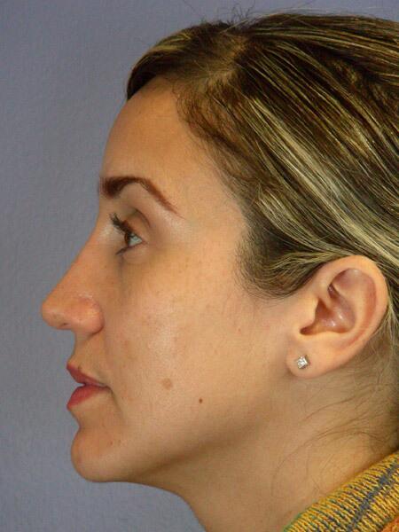 Rhinoplasty Before & After Image