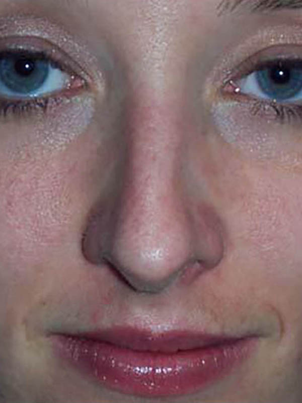 Rhinoplasty Before & After Image