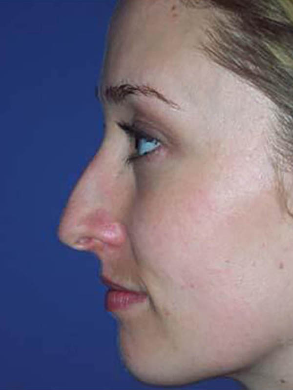 Rhinoplasty Before & After Image