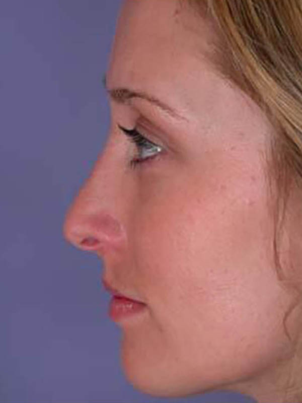 Rhinoplasty Before & After Image