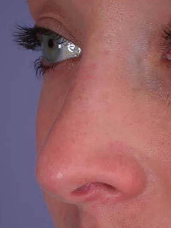 Rhinoplasty Before & After Image