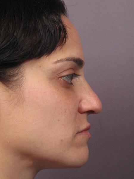 Rhinoplasty Before & After Image