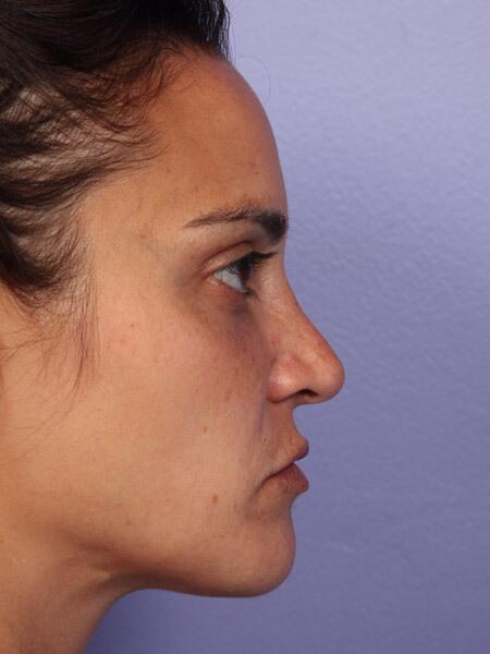 Rhinoplasty Before & After Image