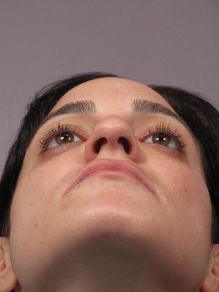 Rhinoplasty Before & After Image