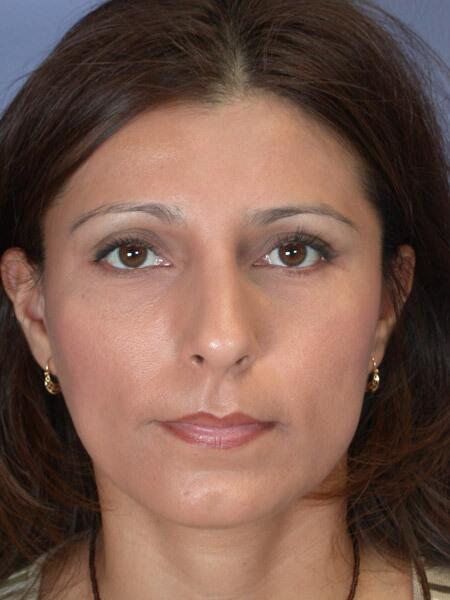 Rhinoplasty Before & After Image