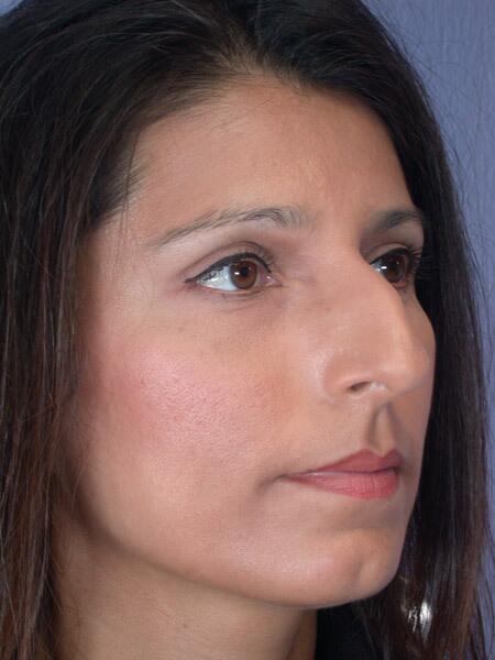 Rhinoplasty Before & After Image