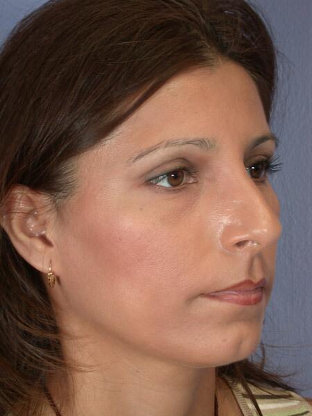 Rhinoplasty Before & After Image