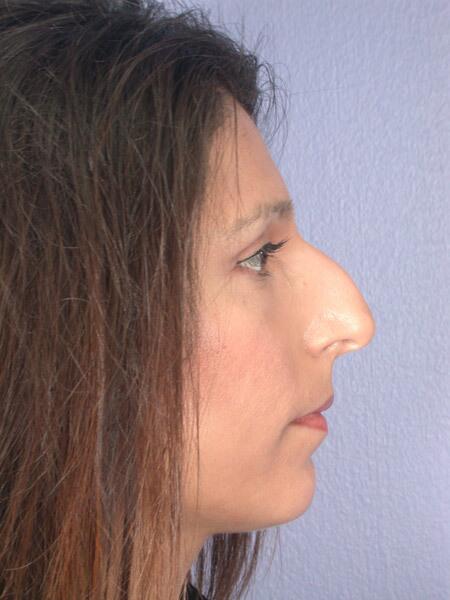 Rhinoplasty Before & After Image