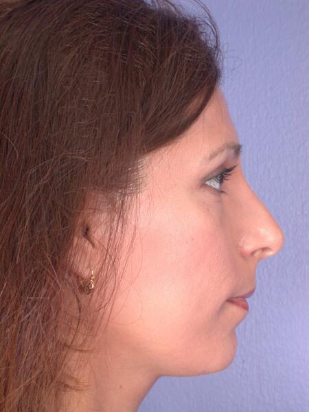 Rhinoplasty Before & After Image