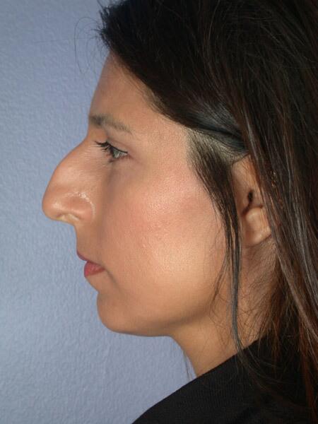 Rhinoplasty Before & After Image