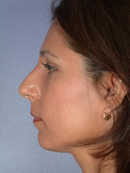 Rhinoplasty Before & After Image