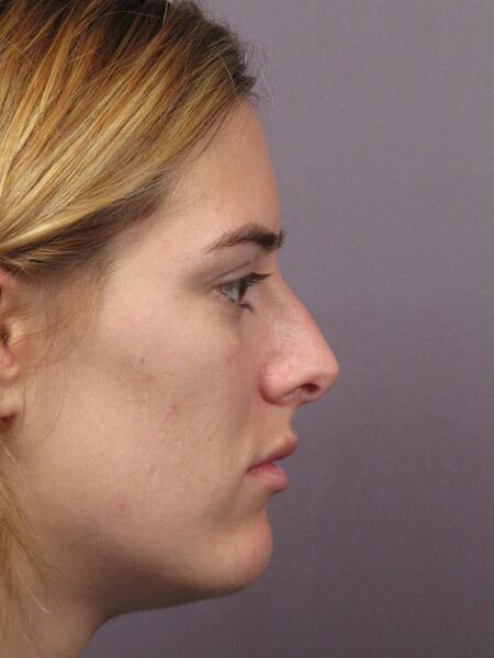 Rhinoplasty Before & After Image