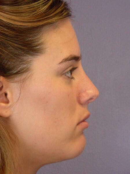 Rhinoplasty Before & After Image