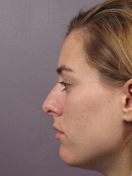 Rhinoplasty Before & After Image