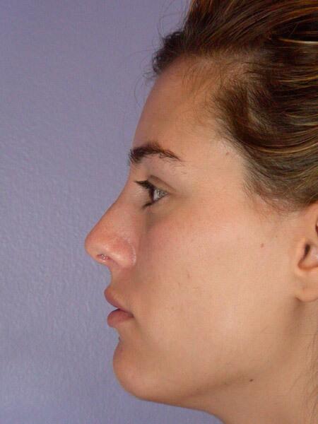 Rhinoplasty Before & After Image