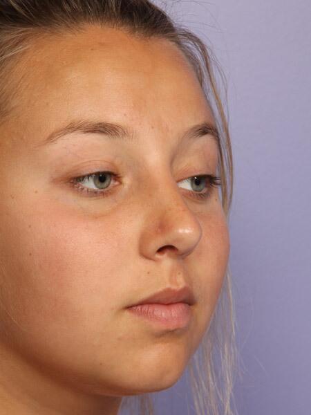 Rhinoplasty Before & After Image