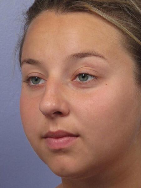 Rhinoplasty Before & After Image