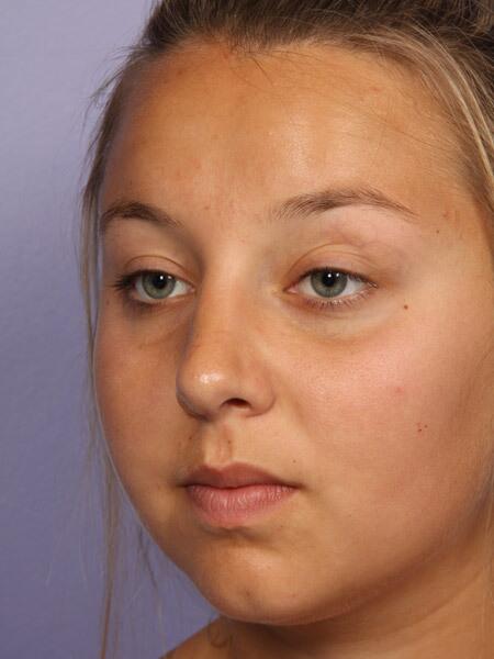 Rhinoplasty Before & After Image