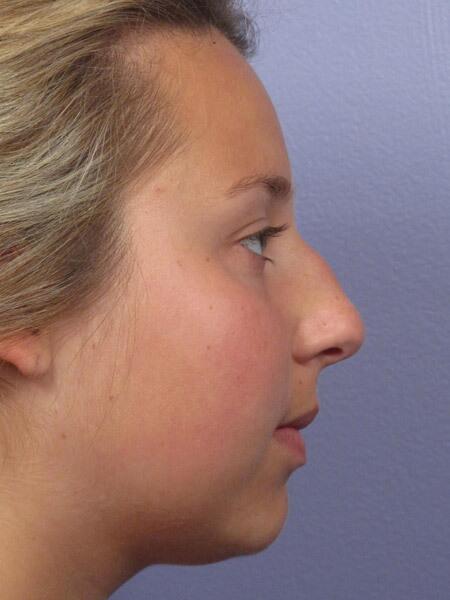 Rhinoplasty Before & After Image