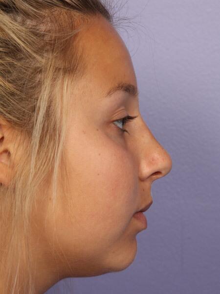 Rhinoplasty Before & After Image