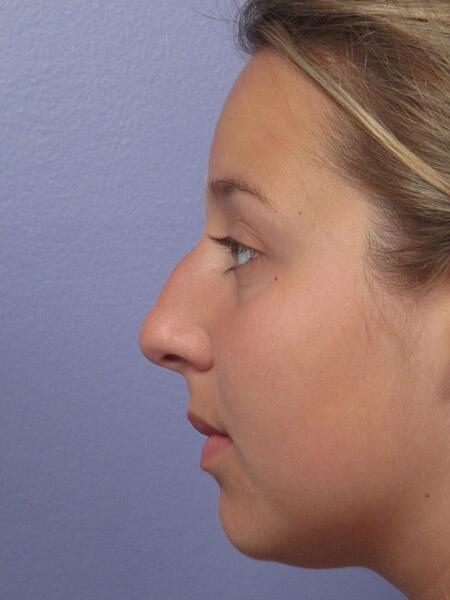 Rhinoplasty Before & After Image