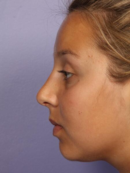 Rhinoplasty Before & After Image