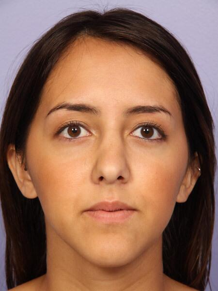 Rhinoplasty Before & After Image