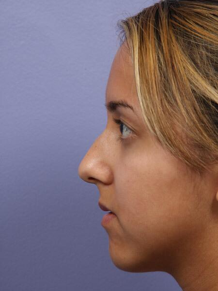 Rhinoplasty Before & After Image