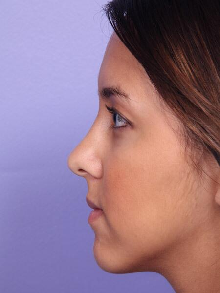 Rhinoplasty Before & After Image