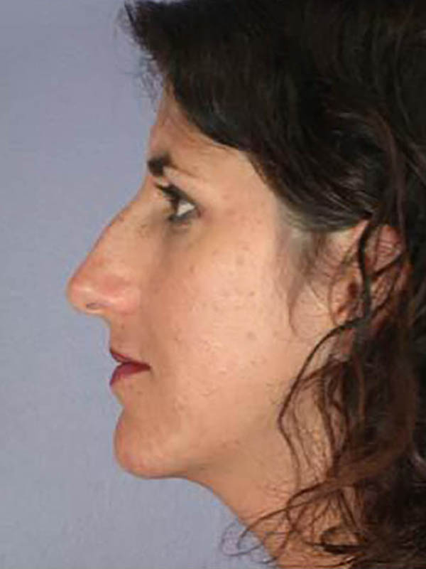 Rhinoplasty Before & After Image