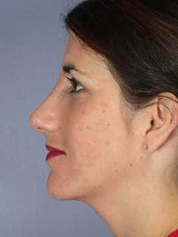 Rhinoplasty Before & After Image