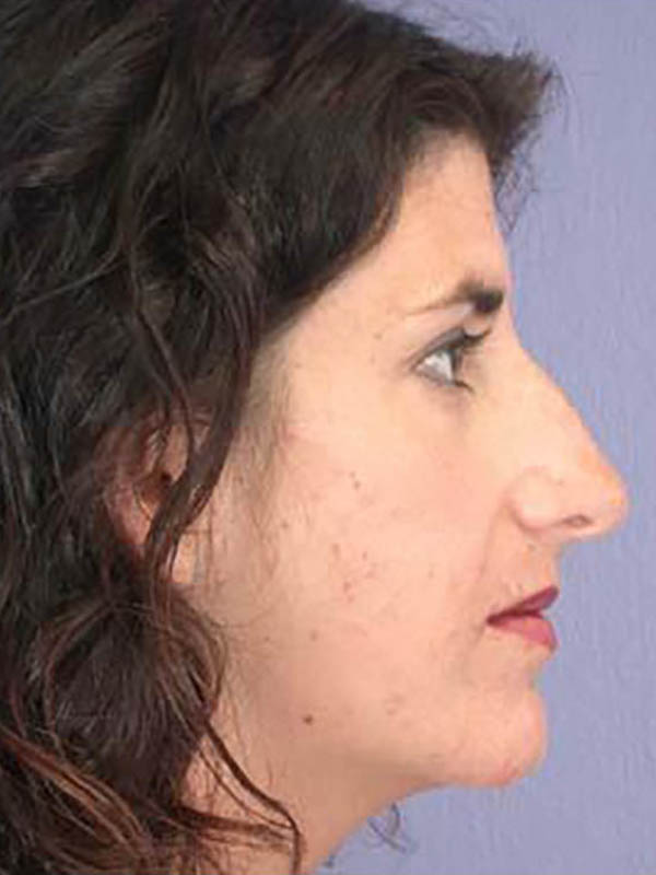 Rhinoplasty Before & After Image