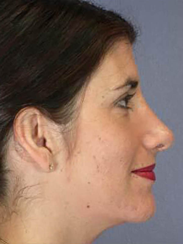 Rhinoplasty Before & After Image